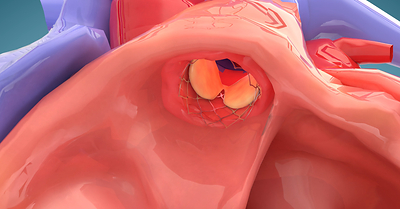 Render of GrOwn Valve's implanted autologous pulmonary valve.