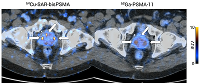 Figure 1. Intra-individual concordant lesion comparison of PSMA PET/computed tomography (CT) between 64Cu-SAR-bisPSMA (left image) and 68Ga-PSMA-11 (right image). The same participant is shown with concordant intraprostatic lesions indicated by white arrows, illustrating greater lesion conspicuity and tracer uptake with 64Cu-SAR-bisPSMA.